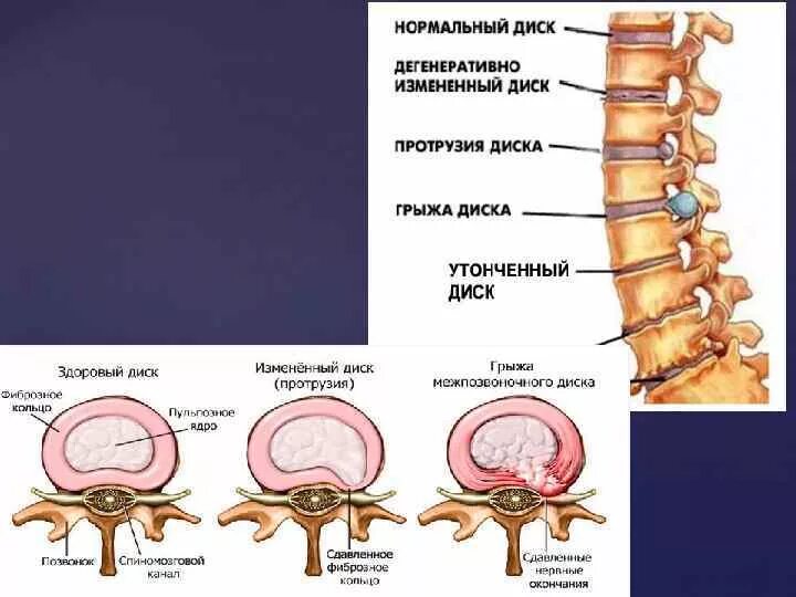 Протрузия дисков позвоночника фото Протрузии дисков шейного отдела с5 с7