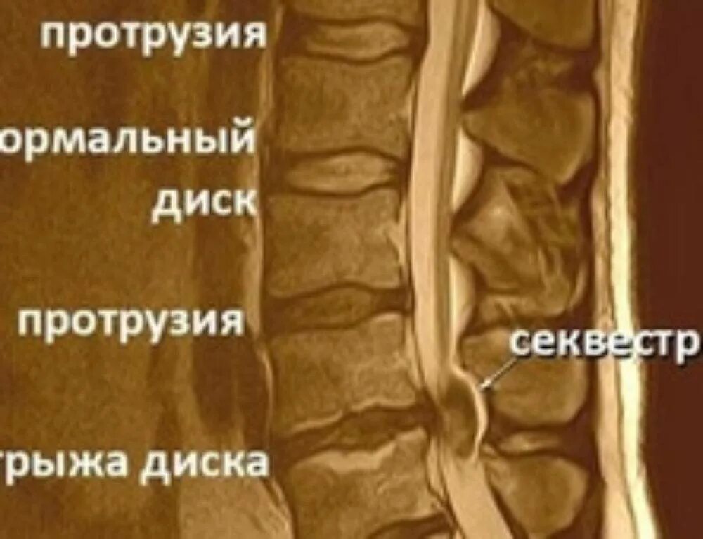 Протрузия дисков позвоночника фото Картинки УМЕРЕННАЯ ПРОТРУЗИЯ ДИСКОВ ПОЗВОНОЧНИКА