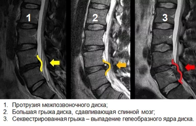 Протрузия дисков позвоночника фото Исследование поясничного отдела позвоночника: найдено 89 изображений