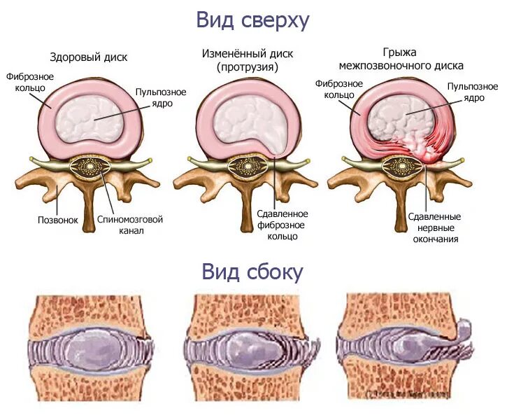 Протрузия дисков позвоночника фото Протрузия межпозвонкового диска - симптомы, диагностика, методы лечения