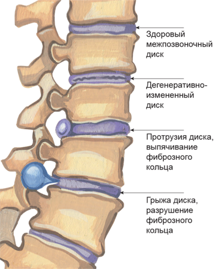 Протрузия дисков позвоночника фото Грыжи межпозвоночных дисков - симптомы, виды межпозвоночных грыж, лечение и удал