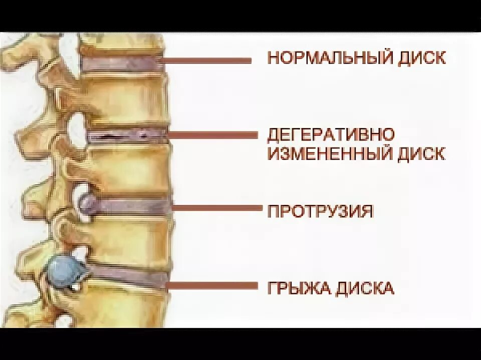 Протрузия дисков позвоночника фото RAIN и межпозвонковая грыжа - YouTube