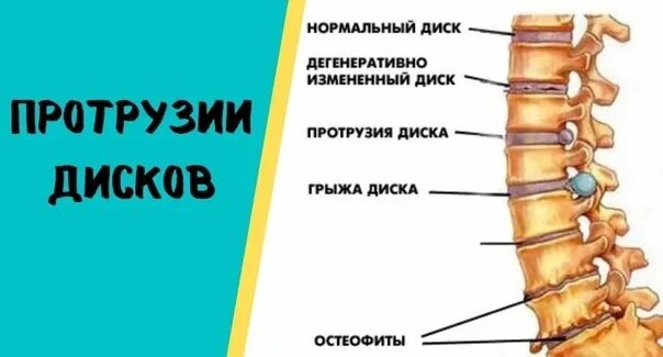 Протрузия дисков позвоночника фото У ВАС ПРОТРУЗИИ! МОЖНО, пройти процедуру АКУПРЕССУРУ ПОДЗАТЫЛОЧНЫХ МЫШЦ? Не толь