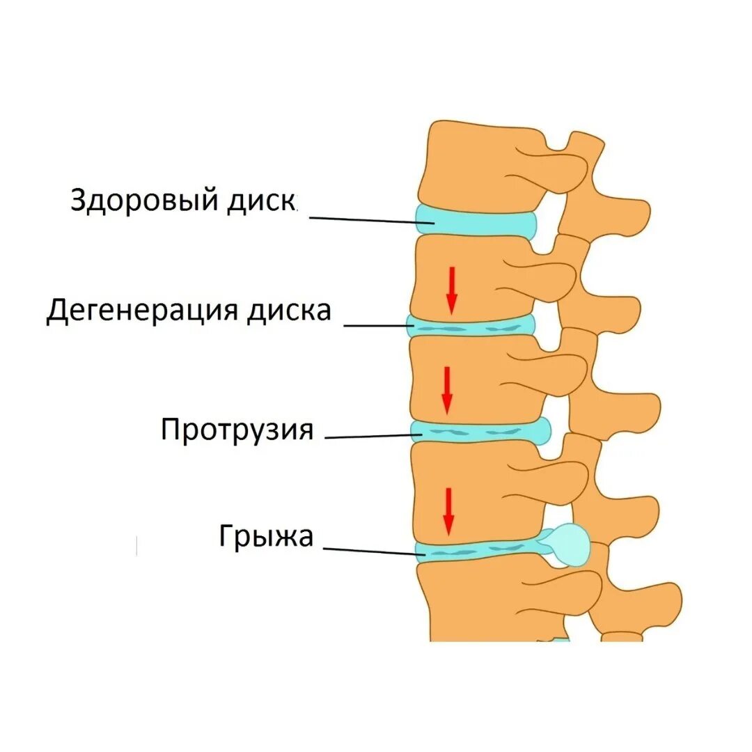 Протрузия дисков позвоночника фото Не дайте протрузии превратиться в грыжу Новости медицинского центра Клиника ДНК