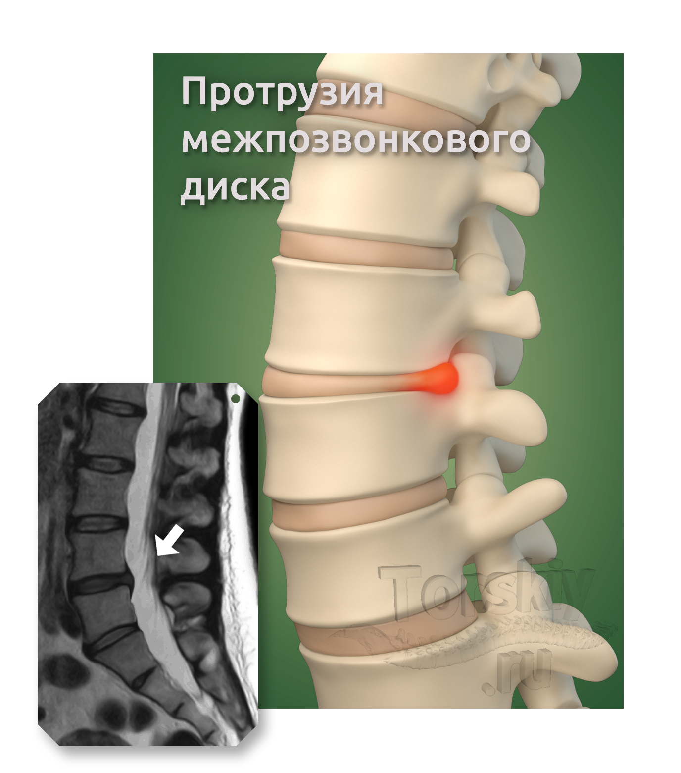 Протрузия дисков позвоночника фото Клиника Доктора Торского Протрузия межпозвонкового диска