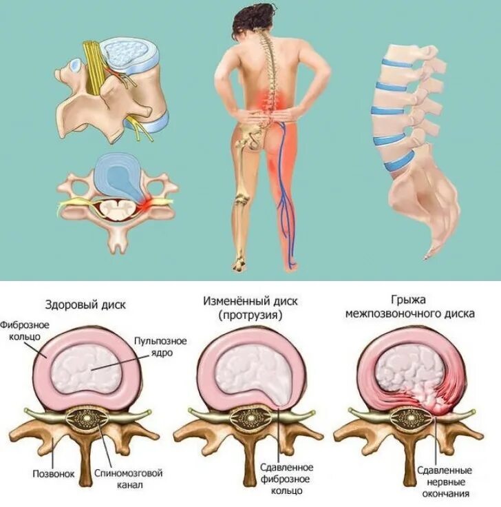 Протрузия дисков позвоночника фото Операция протрузия позвоночника