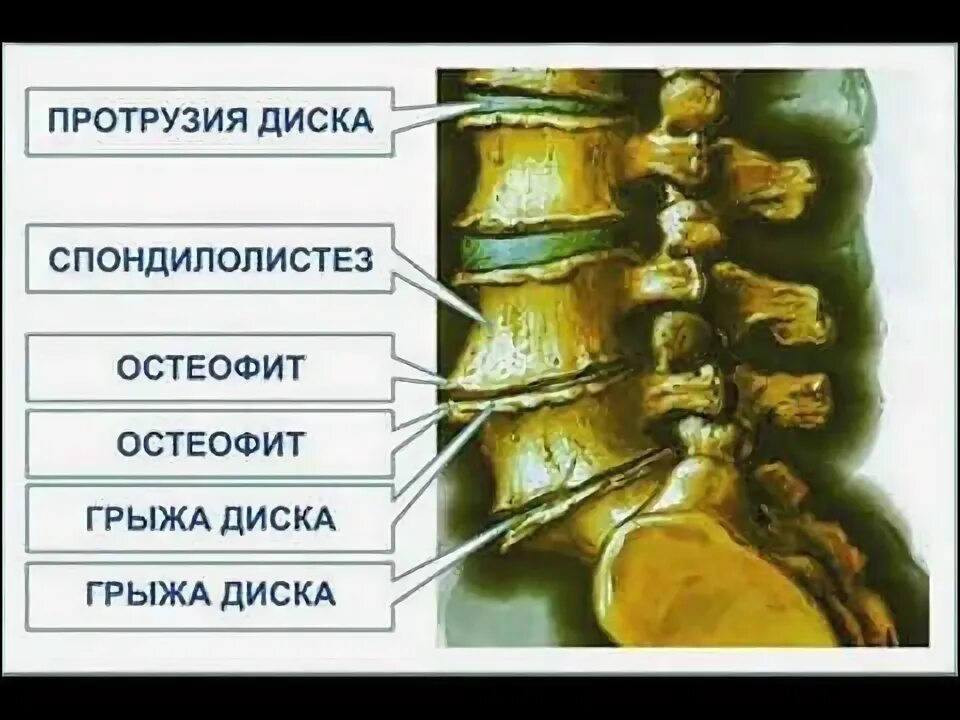 Протрузия дисков позвоночника фото Лечение остеохондроза - YouTube