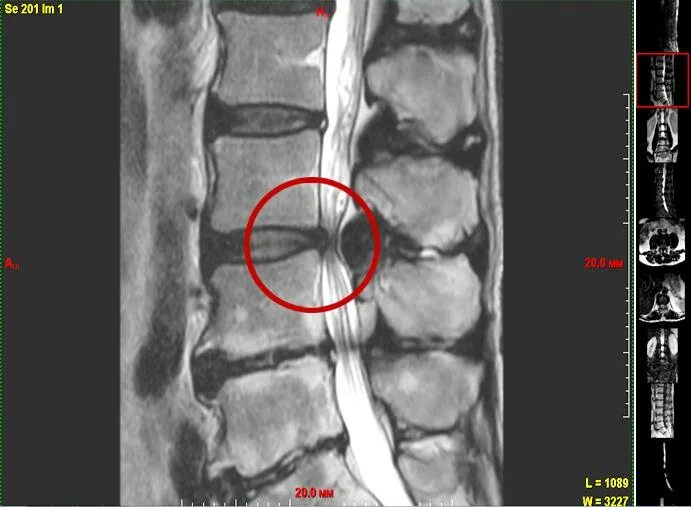 Протрузия поясничного отдела позвоночника фото Протрузии дисков с5 6 7