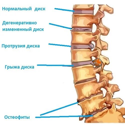 Протрузия поясничного отдела позвоночника фото Дегенеративные изменения позвоночника протрузии