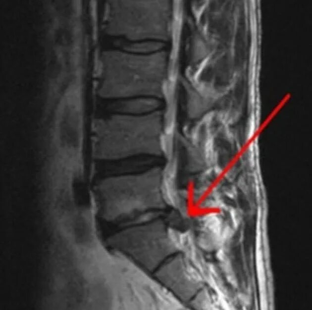 Протрузия поясничного отдела позвоночника фото Lumbociática panosundaki Pin