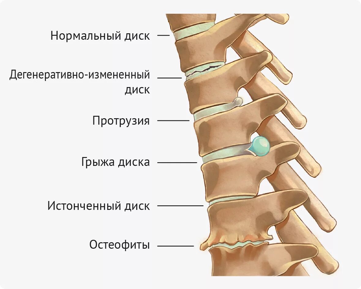 Не дайте протрузии превратиться в грыжу Новости медицинского центра Клиника ДНК