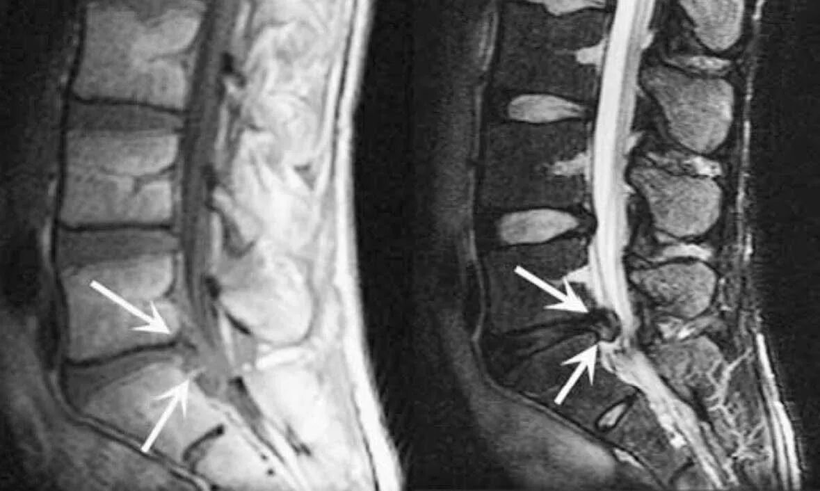 Протрузия поясничного отдела позвоночника фото Заболевания позвоночника