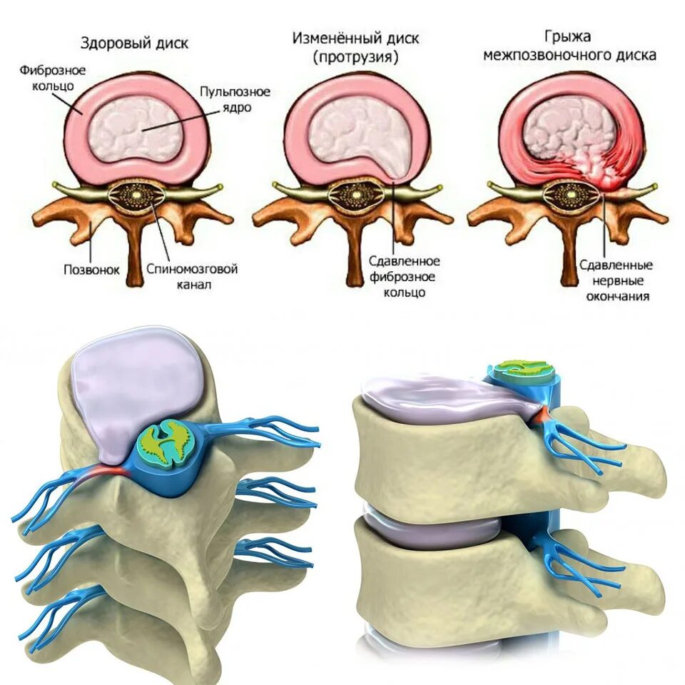 Протрузия поясничного отдела позвоночника фото Картинки ОПЕРАЦИЯ ПОЗВОНОЧНОЙ ГРЫЖИ ПОЯСНИЧНОГО ОТДЕЛА