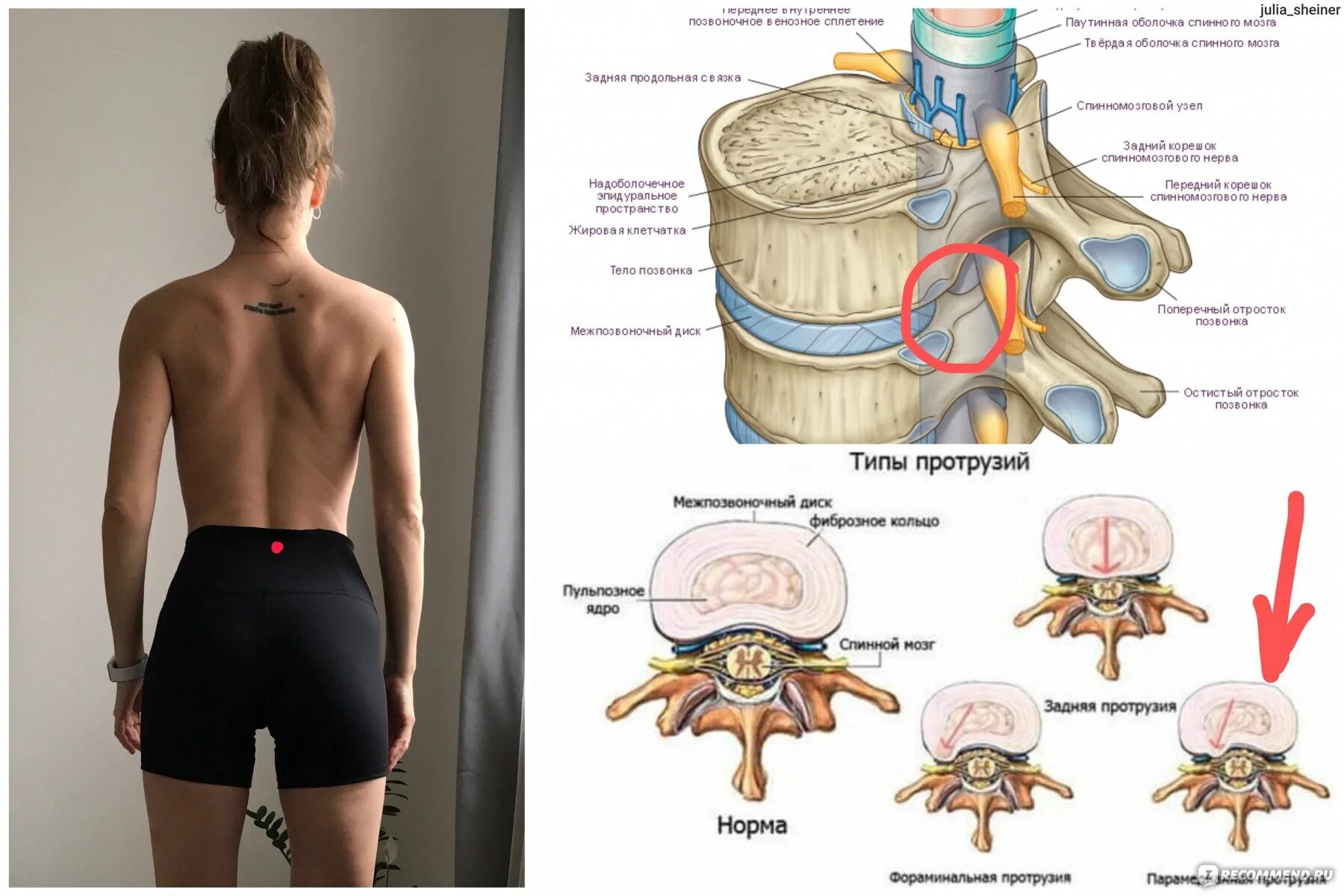 Протрузия поясничного отдела позвоночника фото Операция протрузия позвоночника