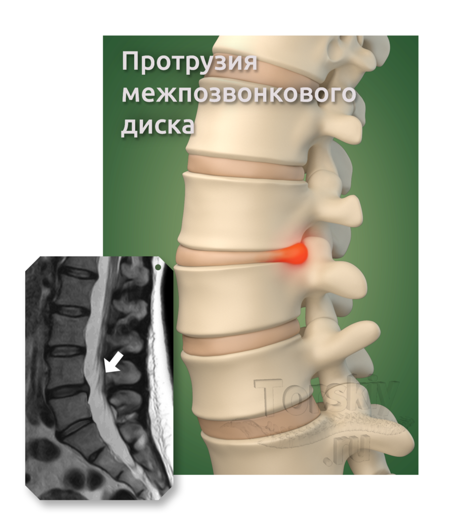 Протрузия поясничного отдела позвоночника фото Дегенеративные изменения позвоночника протрузии