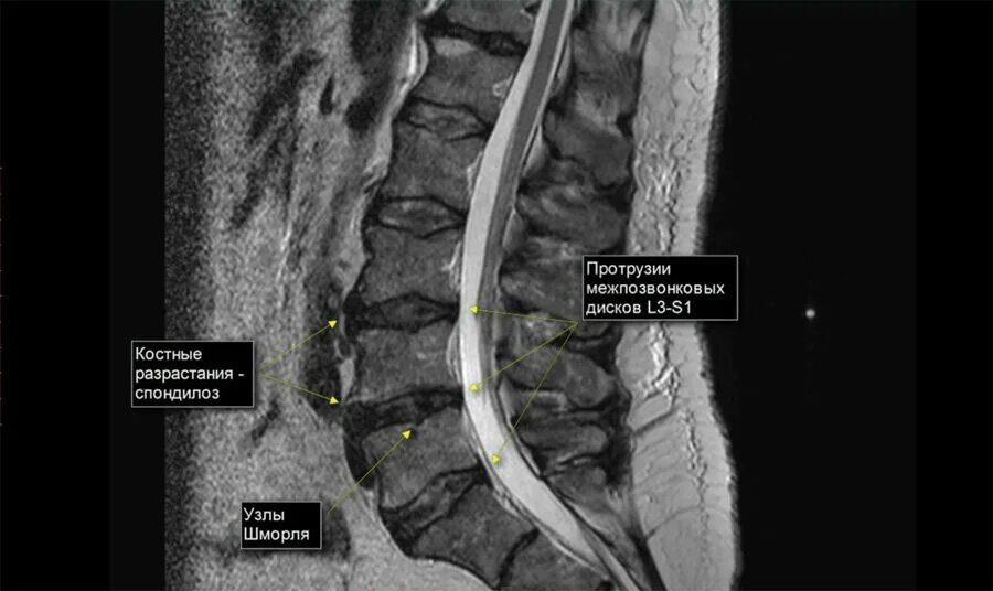 Протрузия поясничного отдела позвоночника фото Протрузия поясничного отдела на МРТ MRT-V Дзен