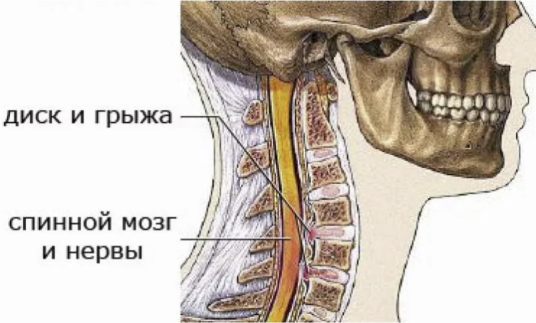 Протрузия шейного отдела фото Последствия грыжи шейного отдела позвоночника: осложнения