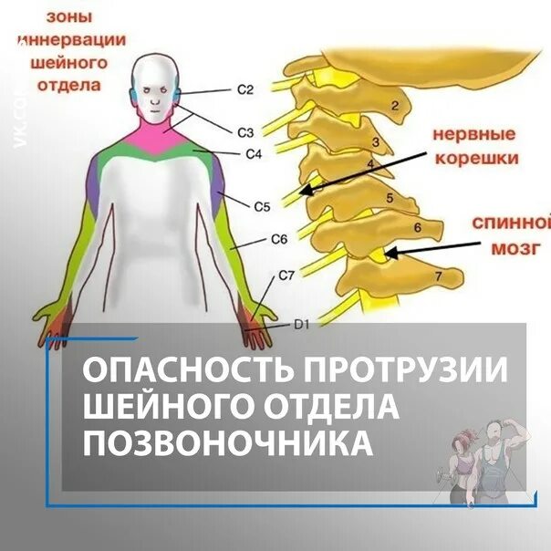 Протрузия шейного отдела фото Протрузия с5 с7 шейного отдела: найдено 87 картинок