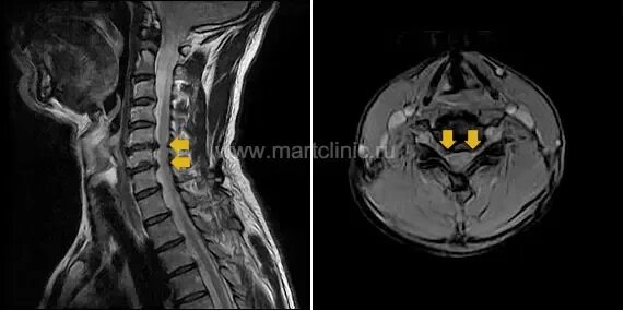 Протрузия шейного отдела фото Лечение межпозвонковой грыжи диска шейного отдела позвоночника в клинике Март в 