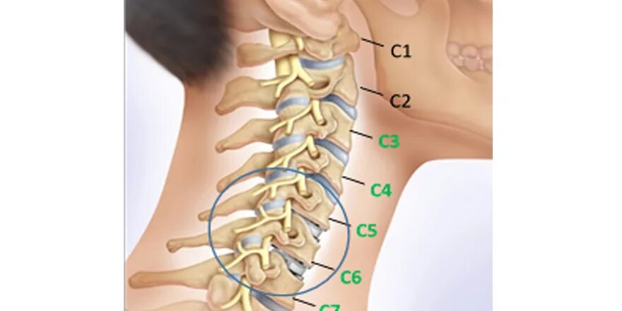 Протрузия шейного отдела фото В шейном отделе позвоночника всегда 5 позвонков