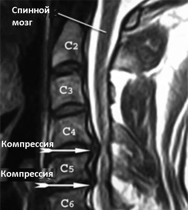 Протрузия шейного отдела фото Протрузия дисков c5 c6: найдено 87 изображений