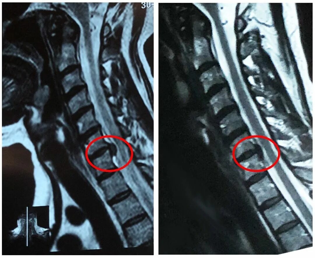 Протрузия шейного отдела фото Операция протрузия позвоночника