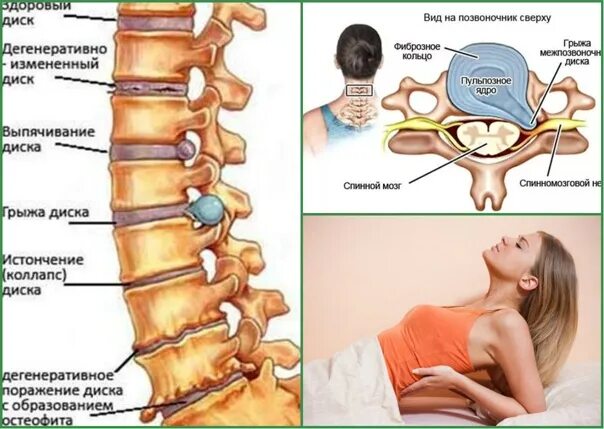Протрузия шейного отдела позвоночника фото Татьяна Паршина: записи профиля ВКонтакте