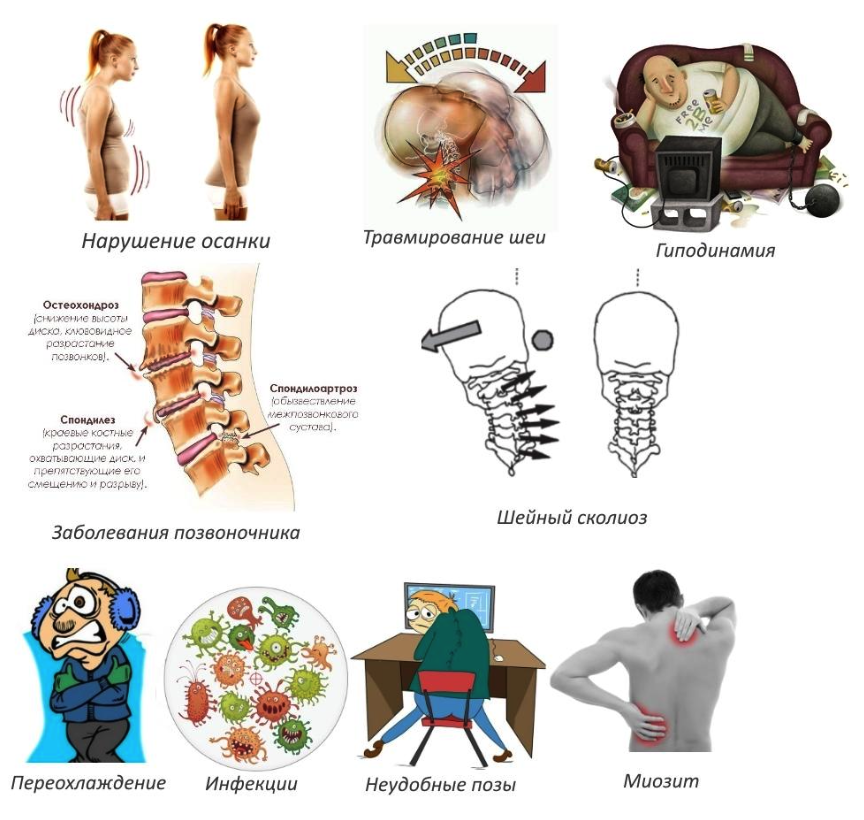 Протрузия шейного отдела позвоночника фото Протрузия шейного отдела: причины, симптомы и лечение