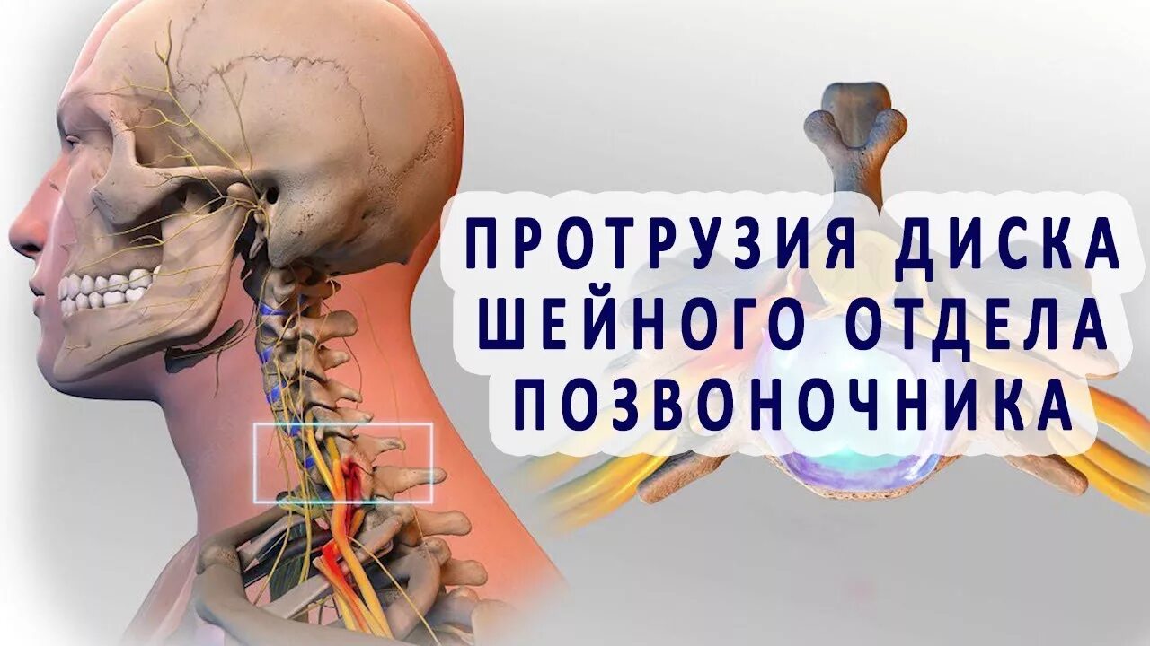 Протрузия шейного отдела позвоночника фото Протрузия дисков шейного отдела позвоночника - YouTube