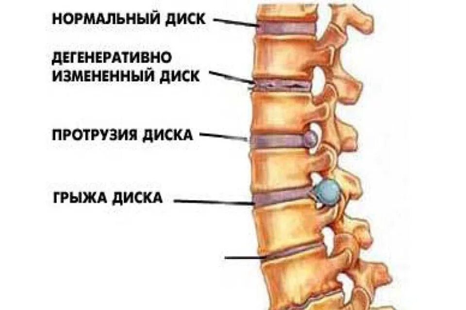 Протрузия шейного отдела позвоночника фото Чем опасны артрит и артроз? - KP.RU
