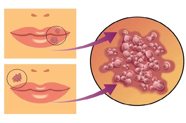 Проявления герпеса фото Герпес на губах!