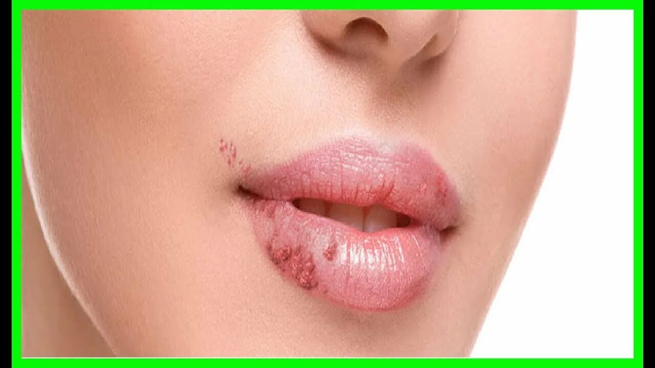 Проявления герпеса фото Remedios Caseros para Acabar con los Herpes Labiales - YouTube