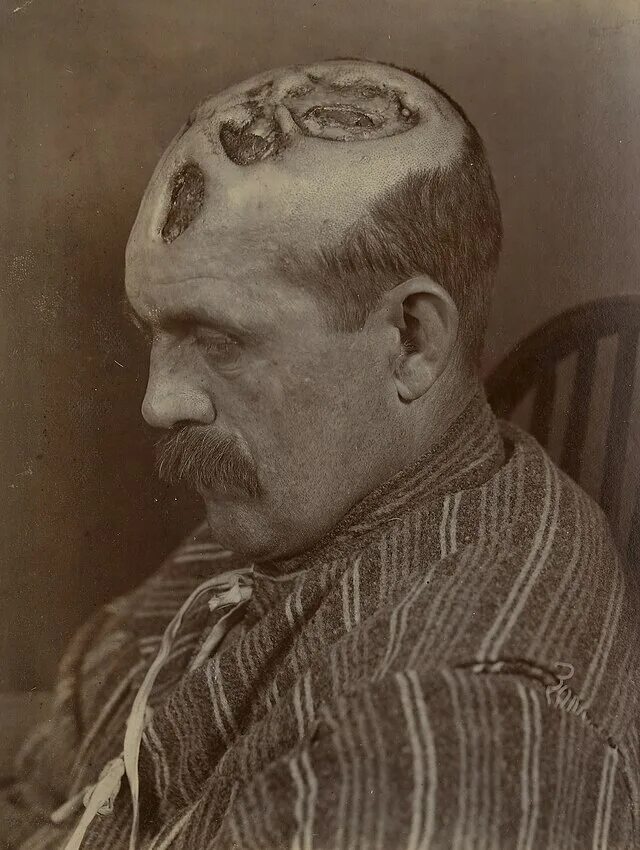 Проявления сифилиса первая стадия фото File:Tertiary syphilitic ulceration of the scalp Wellcome L0062302.jpg - Wikimed