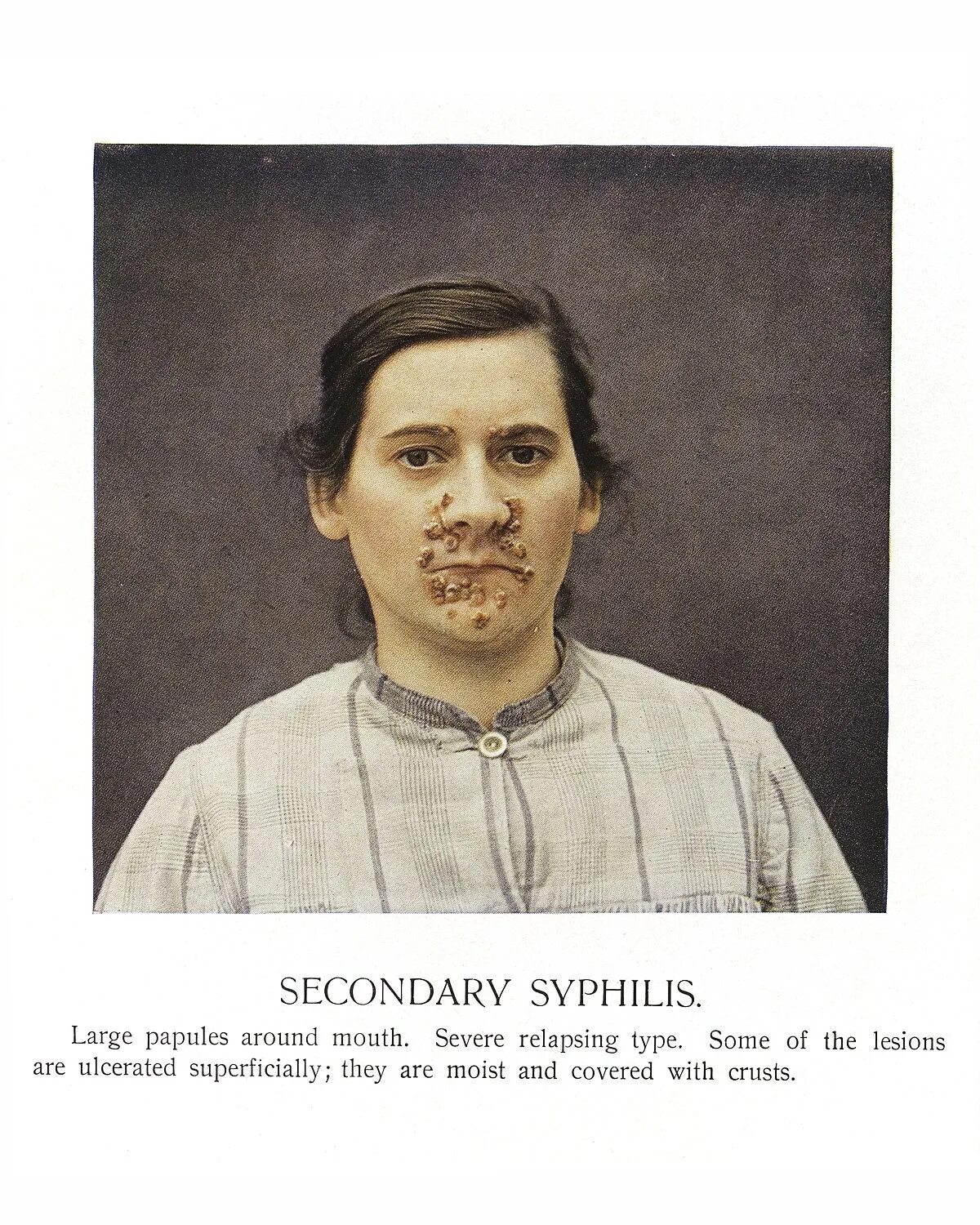 Проявления сифилиса первая стадия фото File:A girl suffering from secondary Syphilis to the face Wellcome L0038260.jpg 