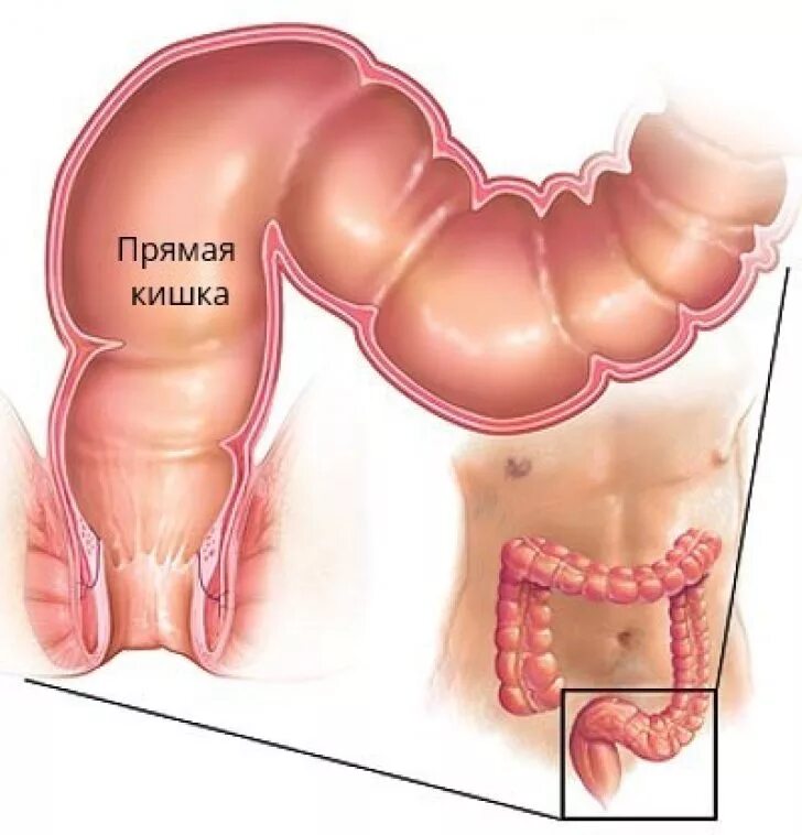 Прямая кишка фото внутри Симптомы и лечение проктита, методы диагностики и профилактики.