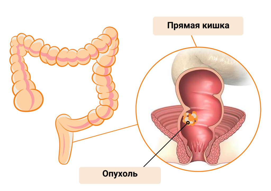 Прямая кишка фото внутри Рак прямой кишки - диагностика, лечение, запись к врачу "ОнкоМедикал"