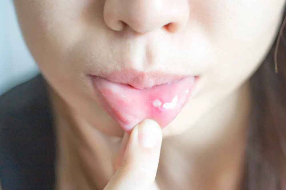 Прыщ на небе во рту фото Find Out What The Appearance Of White Spots On Your Lips Indicates - FamilyToday