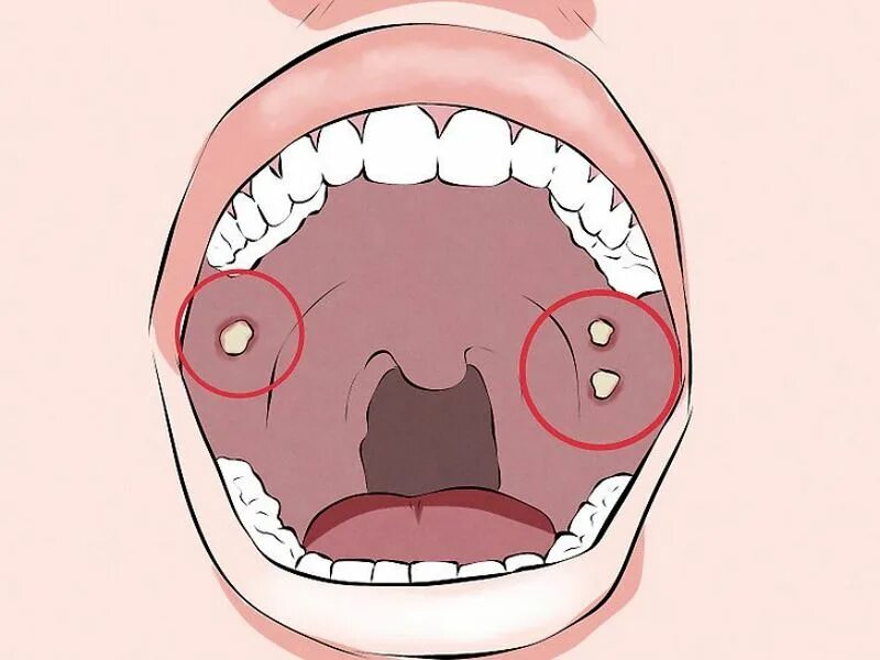 Прыщ на небе во рту фото Диагностика опухолей полости рта