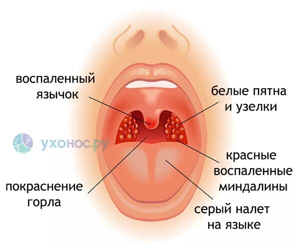 Прыщ на небе во рту фото У грудничка белый прыщик на небе: возможные причины, методы терапии и профилакти