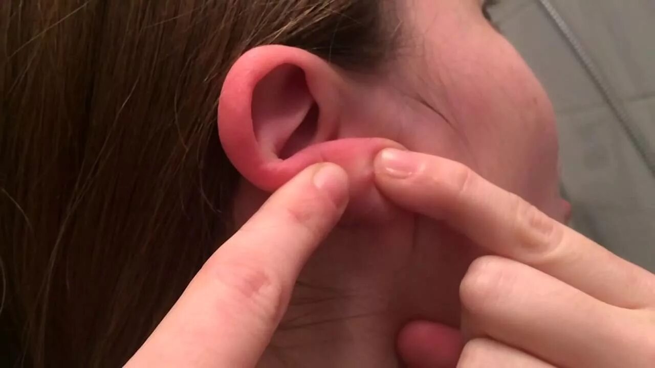 Прыщ в ухе фото earlobe pimple poppin!! (120fps slow motion) - YouTube