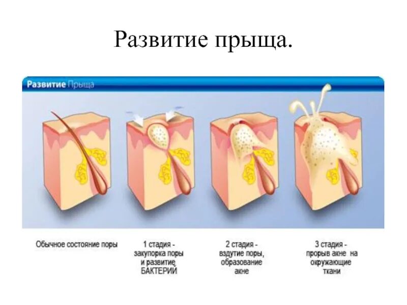 Прыщ внутри фото Кожа - наружный покровный орган.