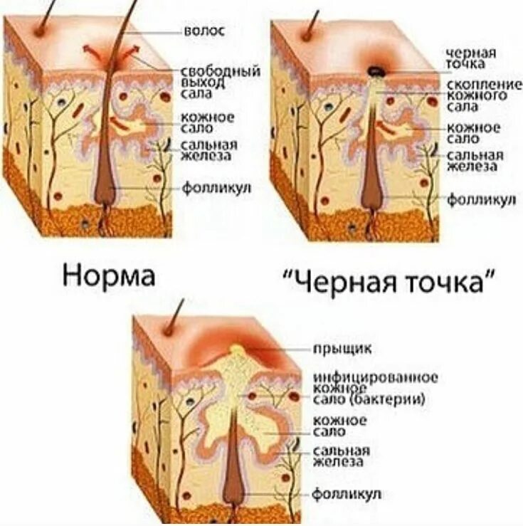 Прыщ внутри фото Pin by Kot on Косметология How to get rid of acne, Squeezing pimples, How to get