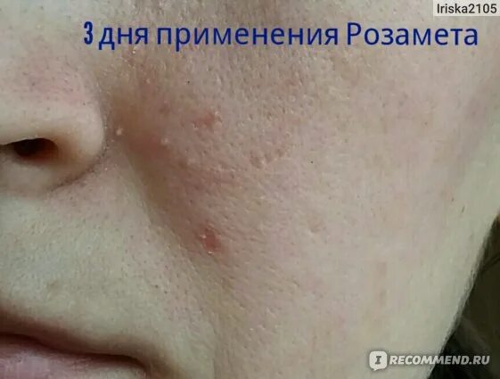 Прыщи клещ фото Противомикробные средства Розамет - "Лечение демодекоза Розаметом. Наконец мне у