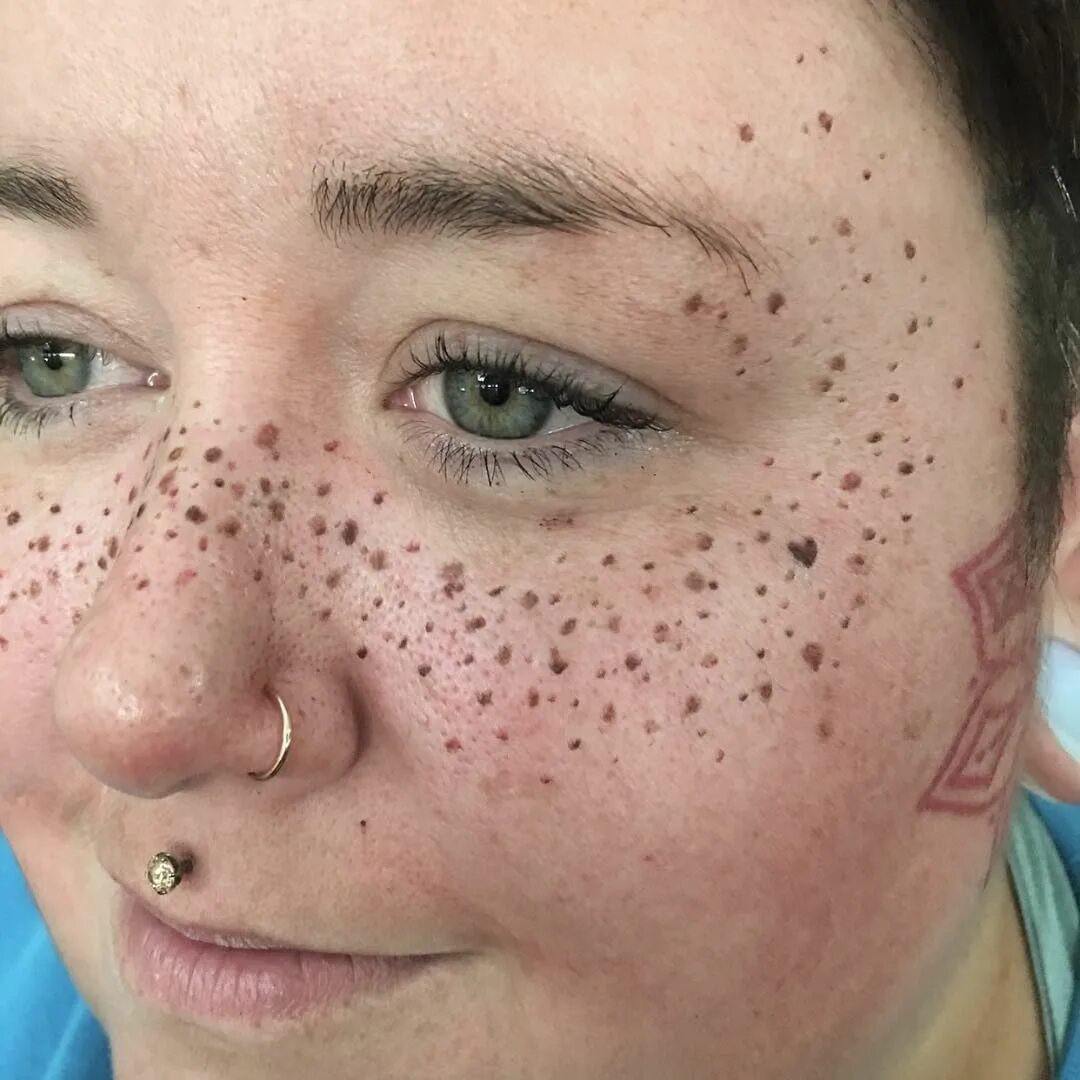 Прыщи на лице фото Not so subtle freckles If you are a tattoo artist or permanent makeup artist who