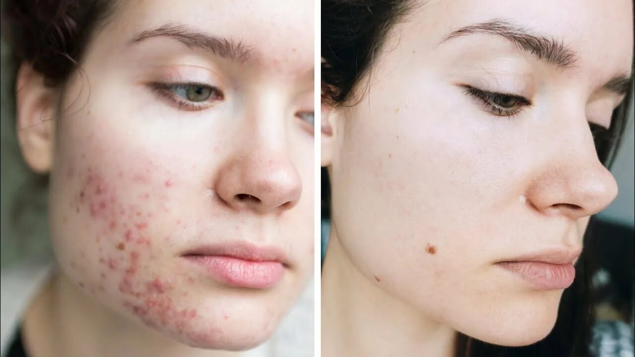 Прыщи на лице у женщин фото Acne Skincare + Overnight Tips & Tricks How To Stop Picking Pimples - YouTube