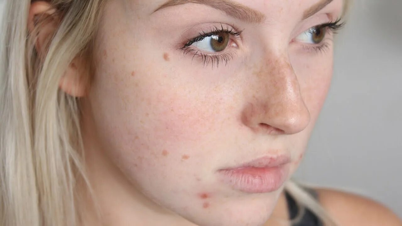 Прыщи на лице у женщин фото How To Get Rid Of A Popped Pimple Overnight dadyKnows - YouTube