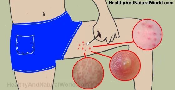 Прыщи на попе фото Effective Ways to Get Rid of Bumps on Inner Thigh (Backed by Science)