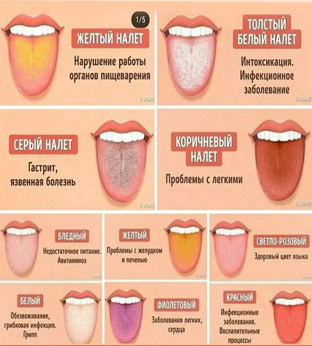 Прыщи на языке у горла фото Белый налет на языке у детей причины