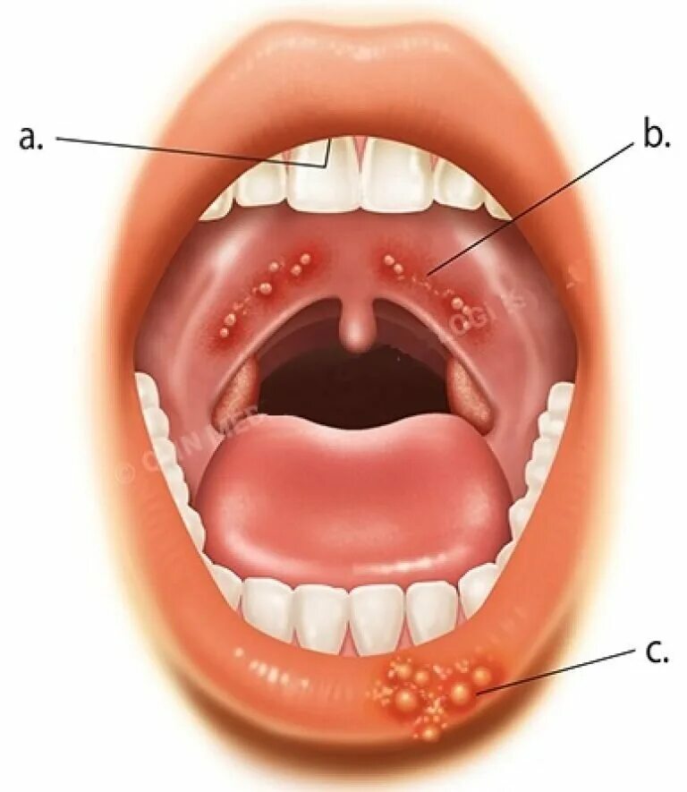 Прыщи на задней стенке горла фото Герпес: причины, симптомы, и лечение вируса пошагово