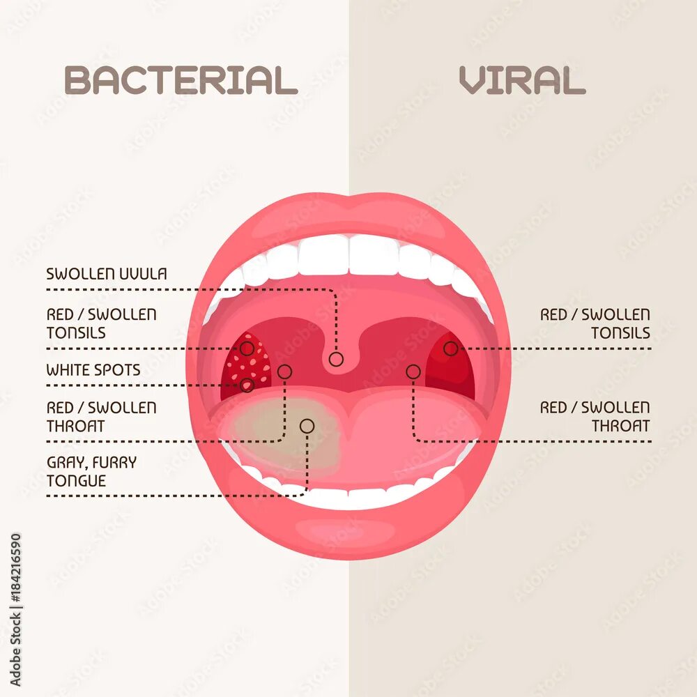 Прыщи на задней стенке горла фото vector illustration of a throat bacterial and viral infection, tonsils inflammat